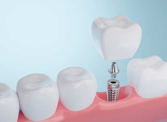 a 3D dental implant model