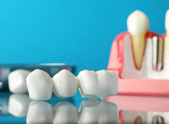 a dental bridge near other dental models