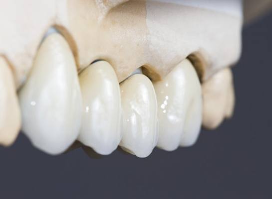 an example of a dental bridge