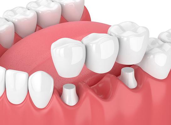 a 3D illustration of a traditional dental bridge