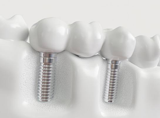 a 3D illustration of an implant dental bridge