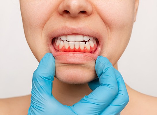 A woman with gum disease