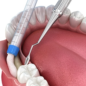 Illustration of a bone graft