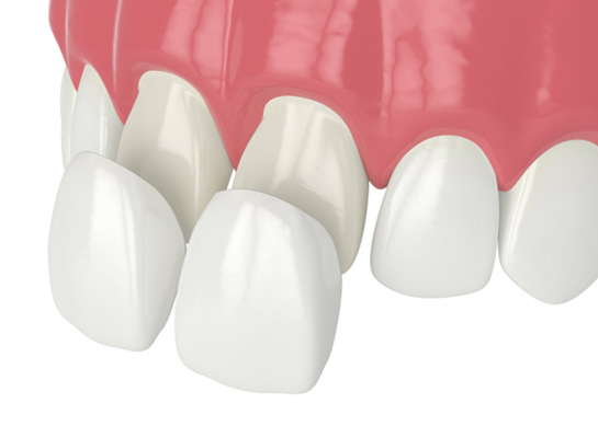 Illustration of veneers being placed on front teeth