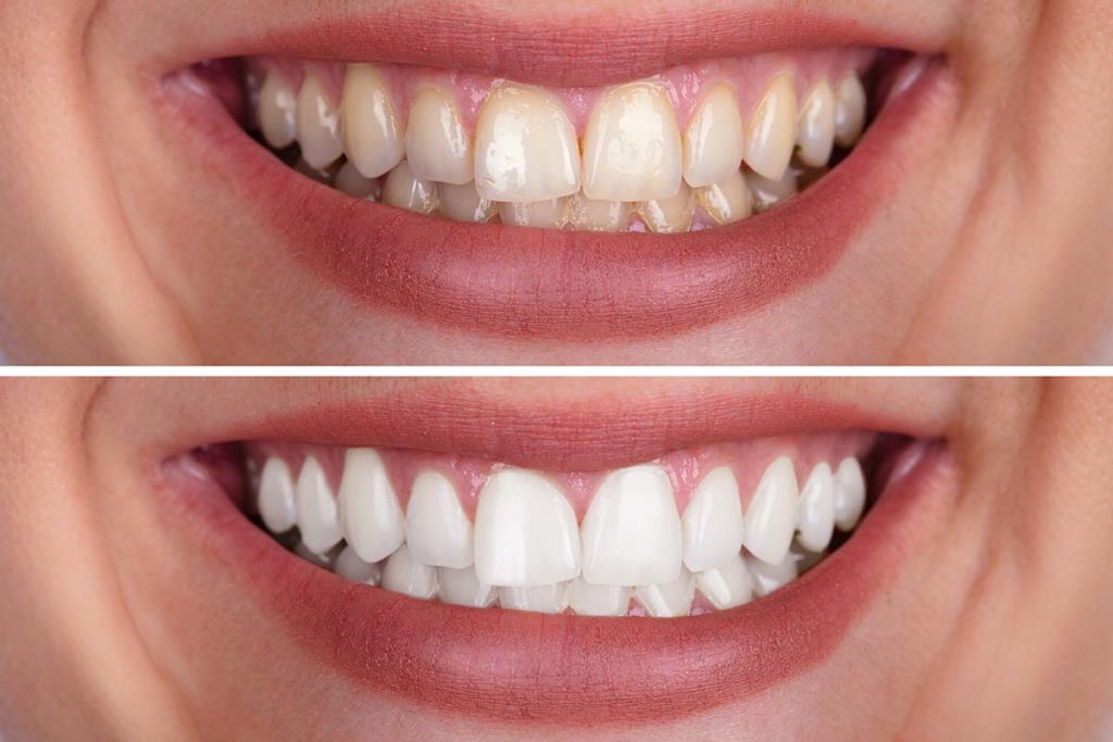 before-and-after-smiles-showing-the-benefits-of-teeth-whitening