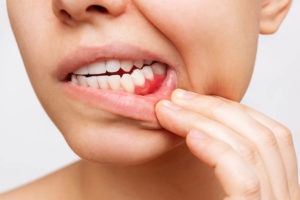 person-checking-mouth-for-early-signs-of-gum-disease