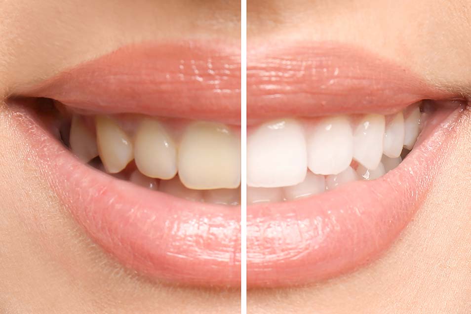 a photo of a mouth shows the difference in shades of color of teeth after teeth whitening and determining is teeth whitening permanent