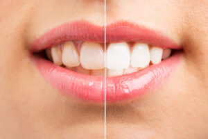 photo of patients before and after teeth whitening as the patient asks is teeth whitening permanent