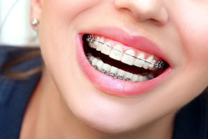 a photo of woman's teeth that indicates she had orthodontic treatments with a retainer on her top teeth and braces on the bottom 