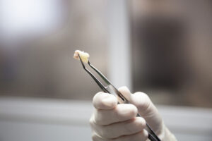 tooth pictured in list about five things to know about tooth extraction
