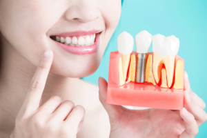woman points at her smile and holds a model representing a dental implant while explaining a dental implant and its cost